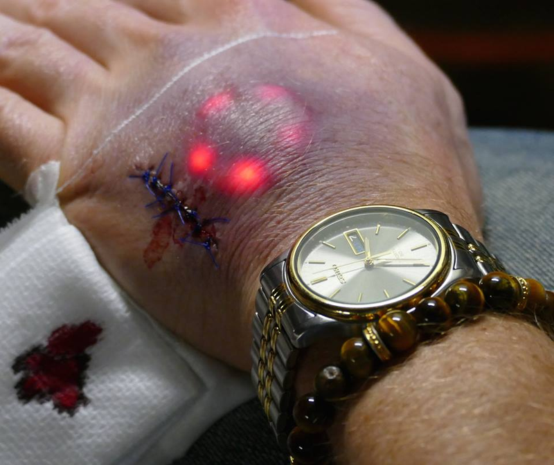 Illustration for article titled The Latest Trend Among Biohackers Is Implanting LED Lights Beneath Your Skin